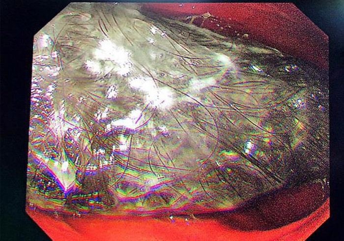 胃镜下发现毛发状胃石巨大且坚硬,占据整个胃腔_副本.jpg 胃镜下发现毛发状胃石巨大且坚硬,占据整个胃腔_副本.jpg