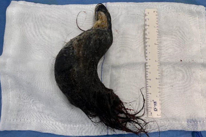 术后取出胃石一枚,形似胃状,长15cm_副本.jpg 术后取出胃石一枚,形似胃状,长15cm_副本.jpg